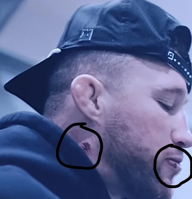 justin-gaethje-staphylocoque